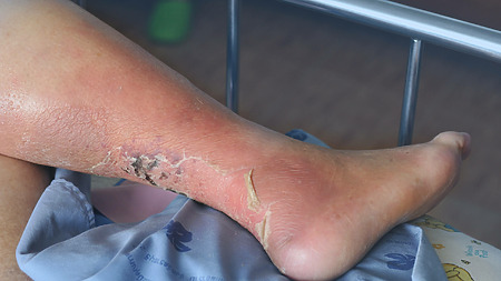 Immagine: Ulcera venosa